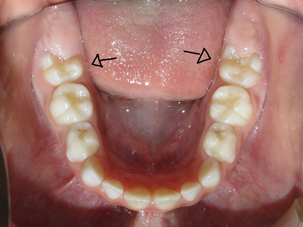 O primeiro molar permanente