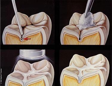 Aplicação do selante no dente, preenchendo os sulcos