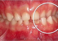Mordida cruzada posterior: dentes inferiores por fora dos dentes superiores